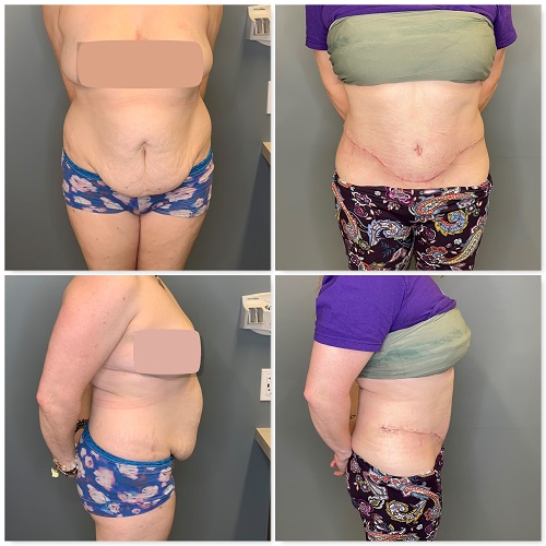 The importance of doing liposuction of the lower back and flanks during a  tummy tuck